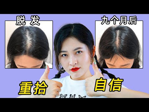 治疗9个月，我的脱发终于得救了，秃头女孩亲测有效。