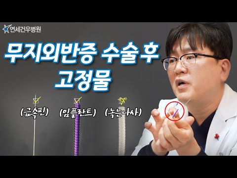 무지외반증, 2차 수술 없는 녹는 나사? #무지외반증 #녹는나사