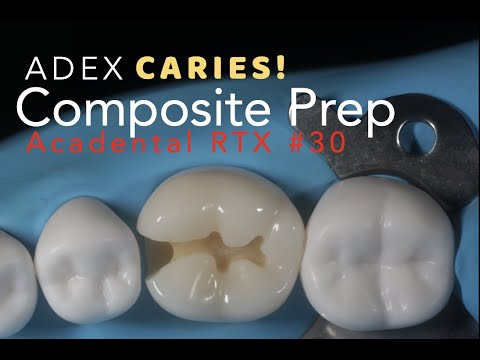 Class II Composite Preparation for ADEX Caries #30 MO
