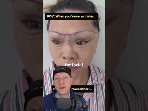 EXTREME Facelift Is Not Hidden At All