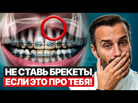Когда НЕЛЬЗЯ ставить брекеты — всего 5 случаев