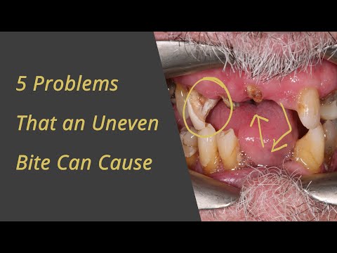 5 Problems and Uneven Bite can Cause