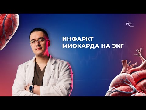 Инфаркт миокарда на ЭКГ