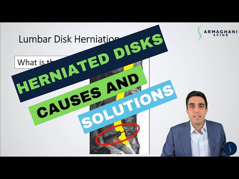 Lumbar Disk Herniation - How did this happen and when when will my sciatica improve?