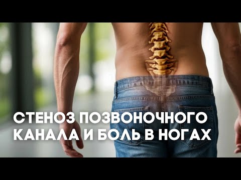 Стеноз позвоночного канала - почему его часто пропускают врачи?