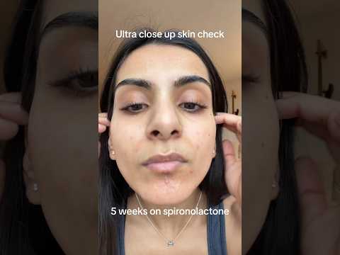 Ultra close up skin check (5 weeks on spiro) #acne #skincare #dermatology #spiro