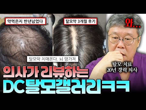 탈모약 효과 최신 근황 ㄷㄷ 디시 탈모갤 털어봤습니다! ㅣ 이제 탈모 극복되나???