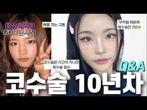 코수술 10년 지났는데 아직도 👃튼튼함? 부작용 생겨서 재수술만 2번 했어요,,, [코 성형전 필독도서 같은 너낌,⭐️]