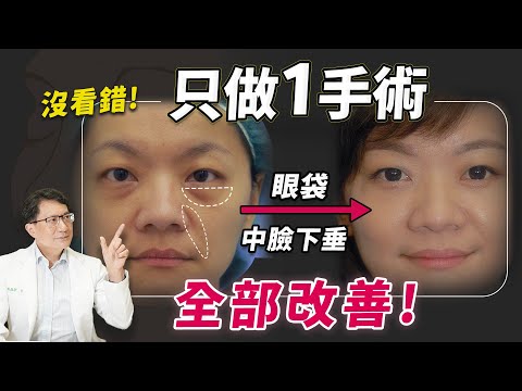 超神奇！一次解決眼袋及顯老下垂？唯一缺點是... 完整講解「眼袋中臉迷你拉皮」手術｜新聖整形外科 楊國輝醫師