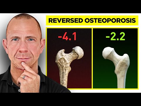 How This 55-Year-Old Woman Naturally Reversed Osteoporosis | Doctor Explains Complete Routine