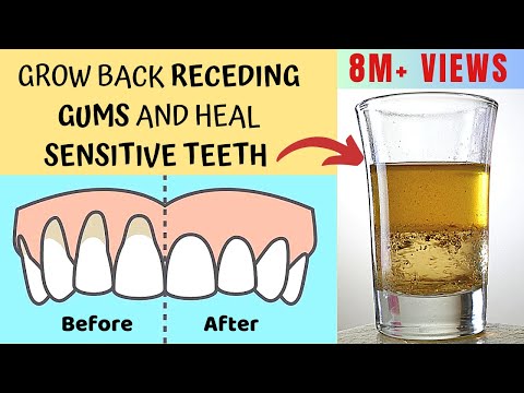Heal Receding Gums and Grow Back | Treat Sensitive Teeth and Reverse Receding Gums | Gingivitis