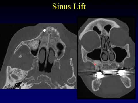 Imaging of the Paranasal Sinuses 5