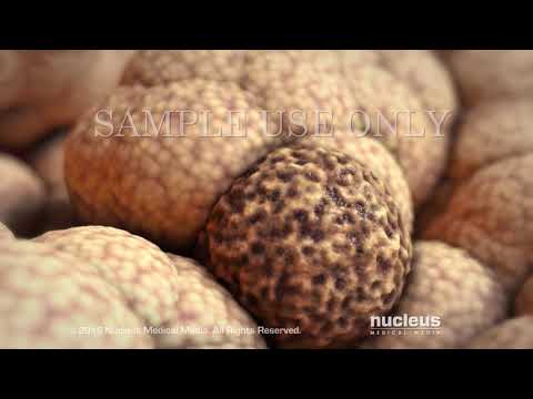 Warning Signs of Prostate Cancer