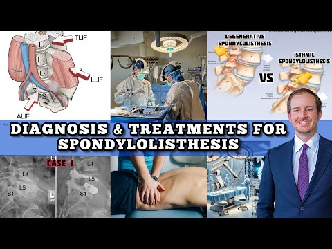 The BEST Video on Spondylolisthesis! How to Diagnose & the Many Treatments (Spine Surgeon)
