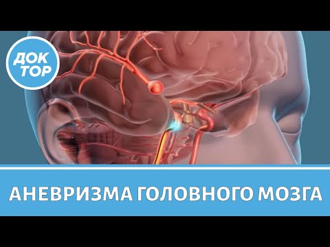 Как жить с аневризмой головного мозга