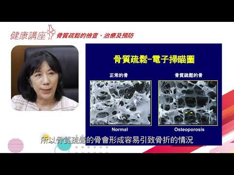 骨質疏鬆的檢查治療及預防