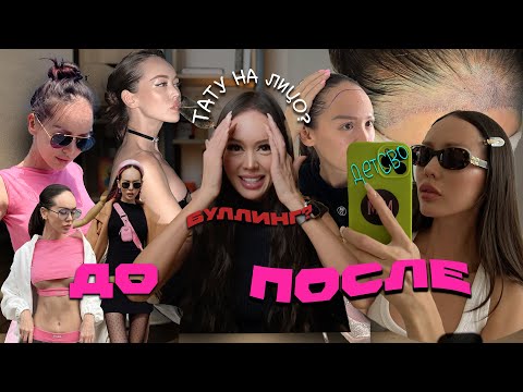 MY HAIR TRANSPLANT STORY!