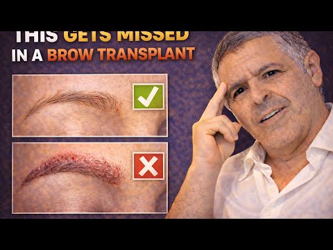 How to Know If an Eyebrow Transplant Will Actually Work for You ?