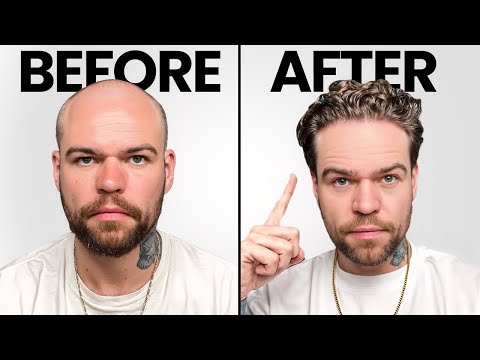 I Got A Turkish Hair Transplant! Before, During and After