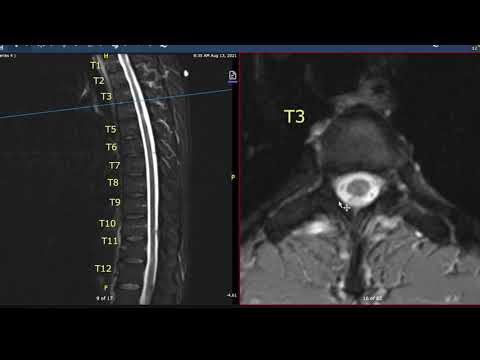 Multiple Sclerosis Vlog: Thoracic Spine MRI