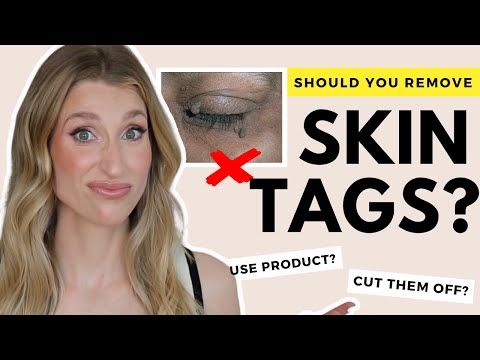 How to Actually Fix Skin Tags | Dr. Sam Ellis