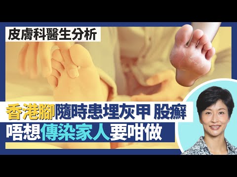 香港腳＝足癬｜皮膚科醫生教你點避免向家人傳播香港腳！香港腳真菌感染亦可致灰甲股癬！頭癬求醫可能要同時醫寵物 動物皮膚癬菌可感染人類｜王建芳醫生 皮膚科醫生何景文醫生｜人類健康研究所