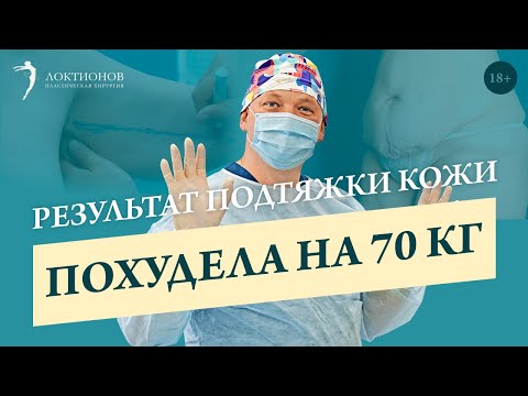 Кожа после похудения на 70 кг // 18+