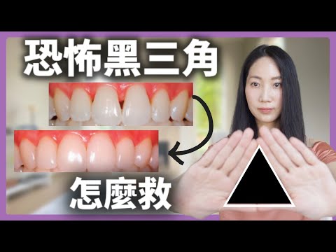 (ENG subs) 不開刀不鑽牙 最有效治療一次全部說清楚@DrGrace