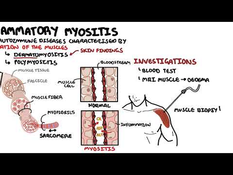 Understanding Inflammatory Myopathies - Dermatomyositis, Polymyositis, Antisynthetase syndrome