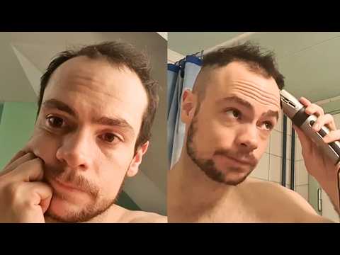 BALDING - "I'm Afraid Of Not Being Attractive"