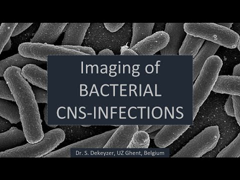 Imaging of bacterial (pyogenic) brain infections