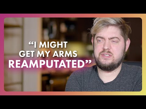 The Man With Another Man’s Arms | Extraordinary People