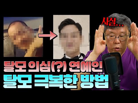 탈모는 돈으로 치료 가능? 와... 이 연예인도 탈모였다고? ㅣ탈모를 극복하는 한가지 방법???