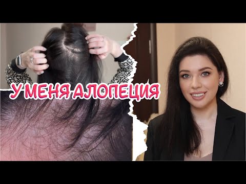 Я ЛЫСЕЮ. Уход при АГА! Миноксидил. Ценные советы. Генетика и наследственность. Облысение у женщин