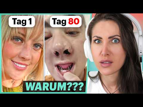 Die Langzeitfolgen von Turkey Teeth...