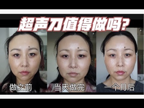 超声刀+Apollo Tripollar测评/一个月后前后对比｜Ultherapy + Apollo Tripollar Review/Before & After[MsLindaY]