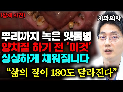 "잇몸에서 피 난다면 양치질 전에 '이것' 해보세요" 돈 한푼 안 들이고 잇몸 치료하는 가장 현실적인 방법 (백승우 원장님 통합본)