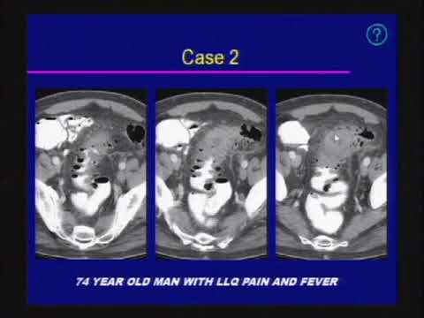Acute Abdomen Imaging [Emergency Radiology]