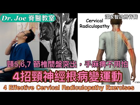 頸5,6,7,節椎間盤突出症、手麻痹⋯⋯怎樣辦？教大家4 招頸神經根病變運動！[Eng Subtitles] 4 Effective Cervical Radiculopathy Exercises