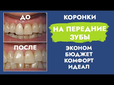 Коронки на передние зубы. Стоимость. Виды.