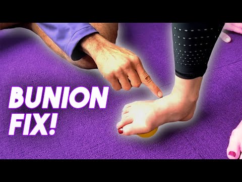 HOW TO FIX A BUNION | Episode 1