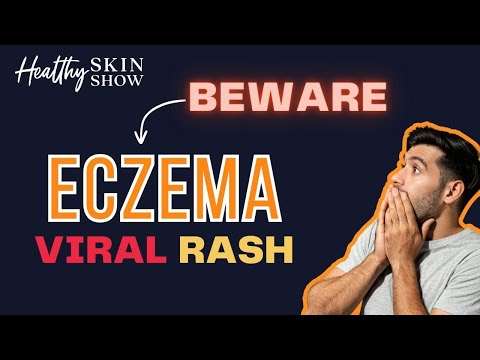 VIRAL Skin INFECTION Signs (aka Eczema Herpeticum) 😱 | Dr. Peter Lio