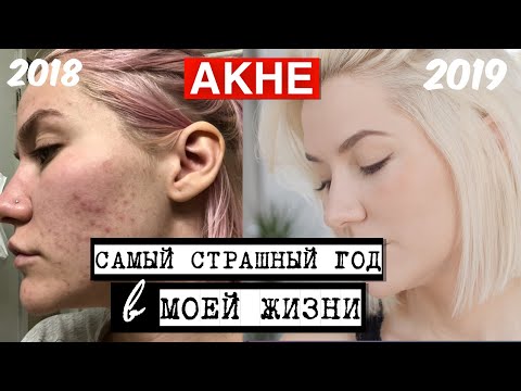 СПАСИТЕ МЕНЯ ОТ АКНЕ | ИСТОРИЯ ЛЕЧЕНИЯ
