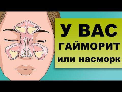 ГАЙМОРИТ. Все о заболевании: причины, симптомы, лечение