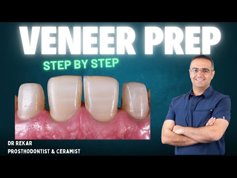 🔹 Step-by-Step Veneer Preparation & Cementation! 🔹 Part One
