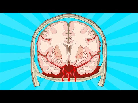 Stroke: subarachnoid haemorrhage