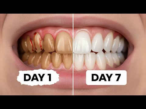 Whiten Teeth FAST at Home — What Dentists Won’t Tell You