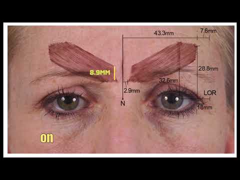In-depth Guide To Treating The Glabella/Forehead With Botox | Dr Chris Hutton