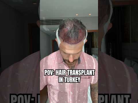 Let’s go to turkey to get a hair transplant.