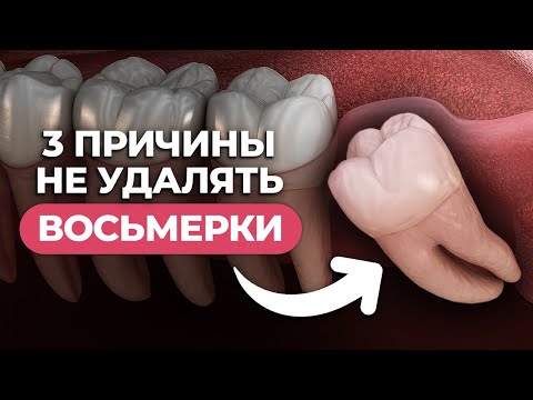 Should wisdom teeth be removed? / All the pros and cons
